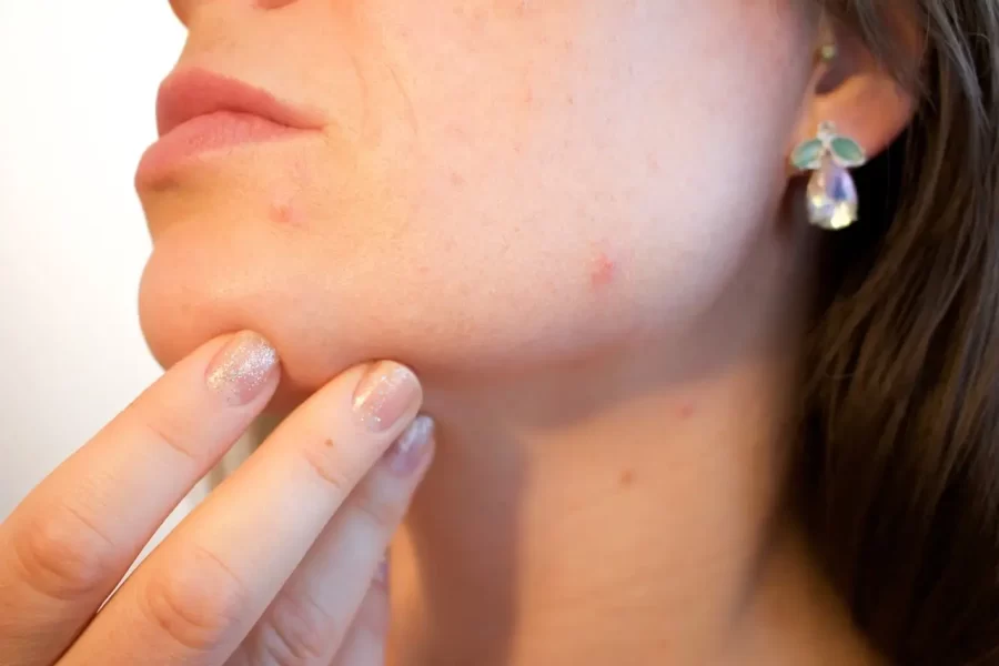 Pimples & Acne: Causes and Treatment, Tips & Remedies
